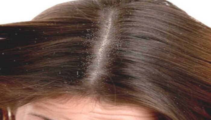 Myths About Grey Hair and Baldness